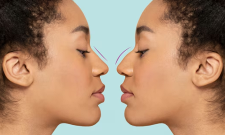 How long does a non surgical nose job last